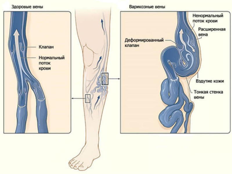 Восемь упражнений против варикоза Восемь упражнений против варикоза