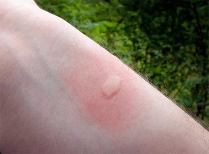 12 видов укусов насекомых и что делать при каждом из них?