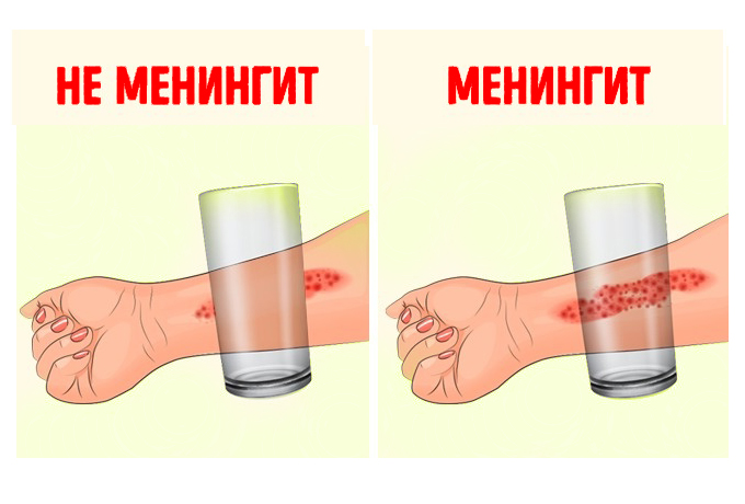 8 признаков менингита, которые должен знать каждый родитель!
