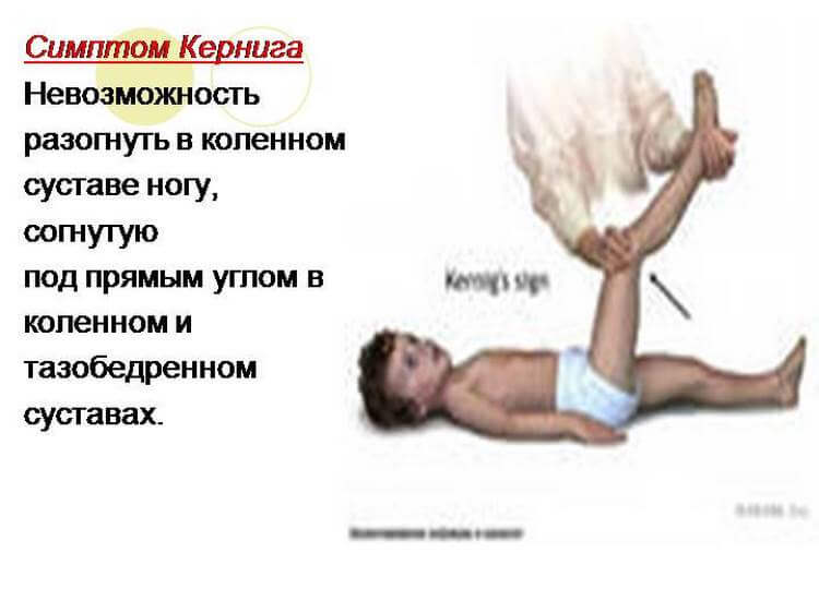 8 признаков менингита, которые должен знать каждый родитель!
