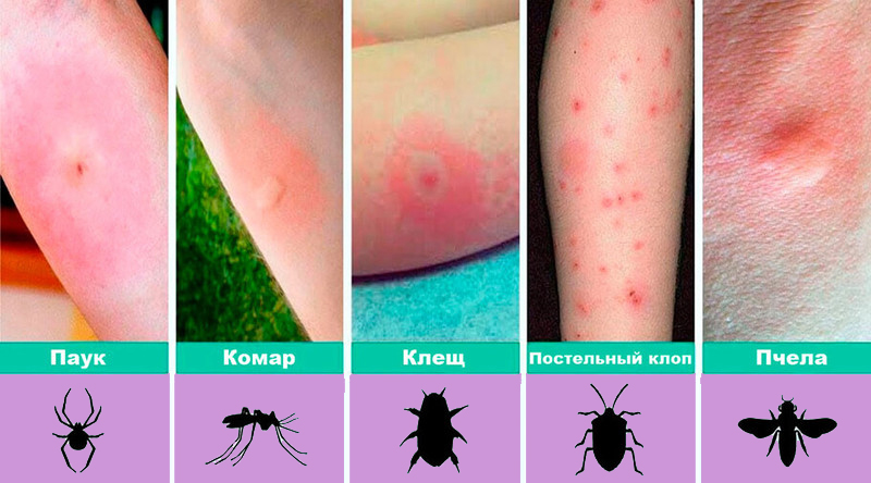 12 видов укусов насекомых и что делать при каждом из них?