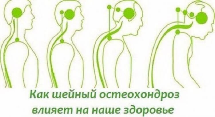 Как уберечься от остеохондроза и как та болезнь влияет на наше состояние