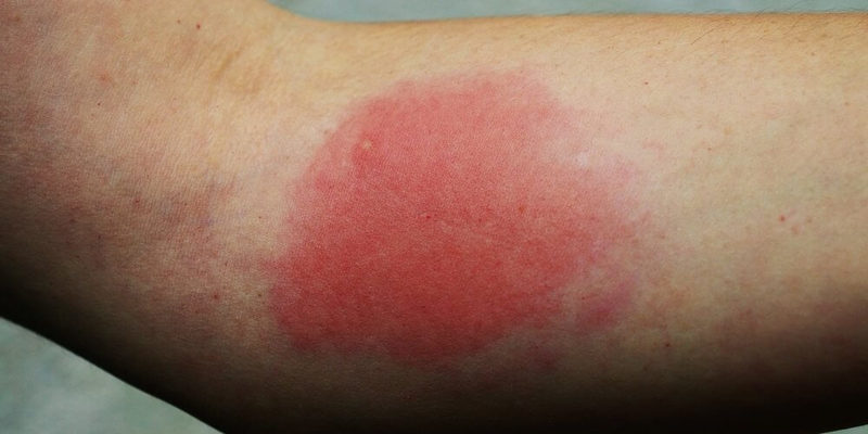 12 видов укусов насекомых и что делать при каждом из них?