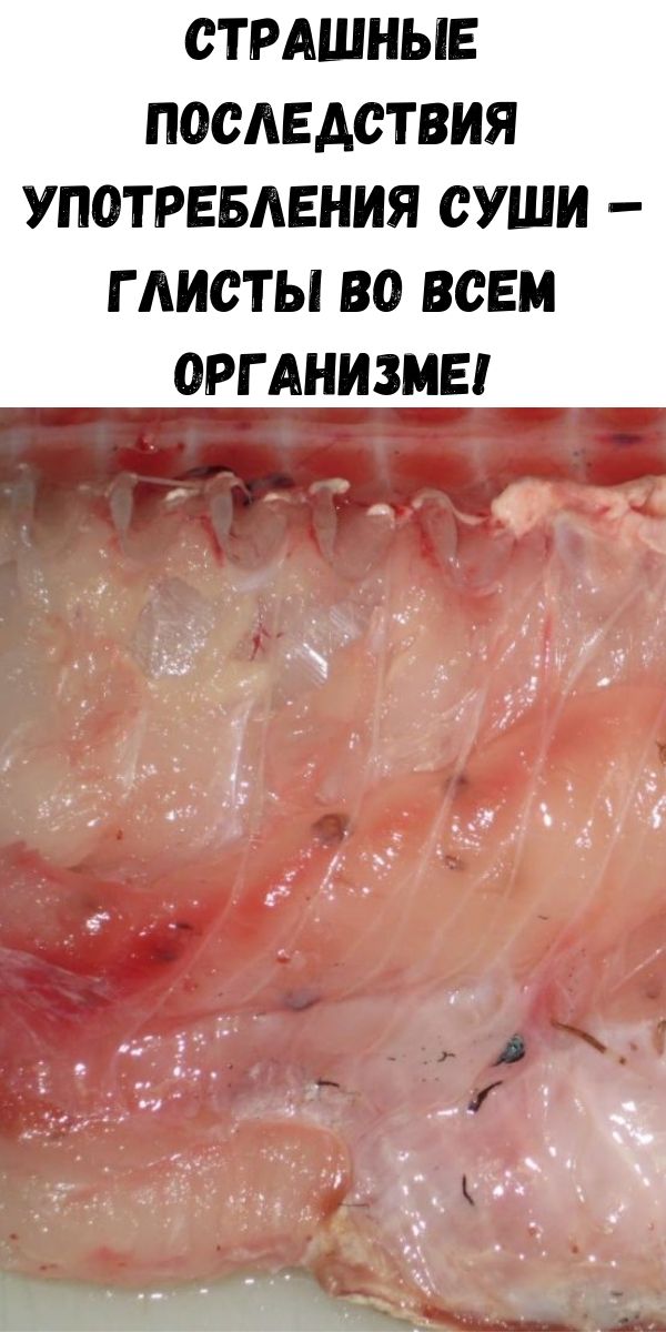 Страшные последствия употребления суши – глисты во всем организме!