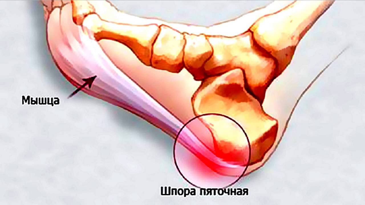 Образования пяточной шпоры. Плантарный фасциит рентген. Подошвенный (плантарный) фасциит. Плантарный фасциит блокада.