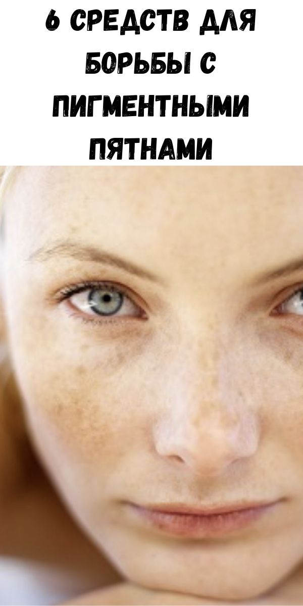 6 средств для борьбы с пигментными пятнами