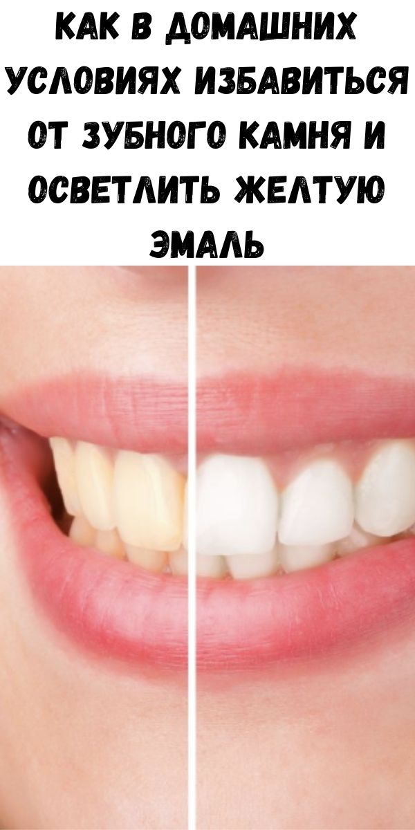 Как в домашних условиях избавиться от зубного камня и осветлить желтую эмаль