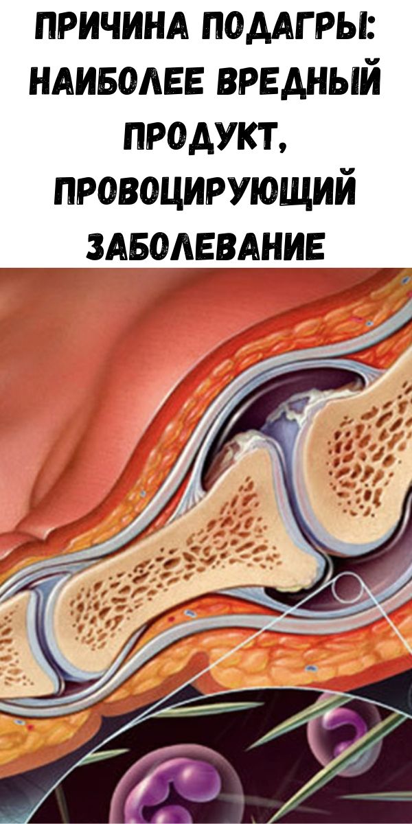 Причина подагры: наиболее вредный продукт, провоцирующий заболевание