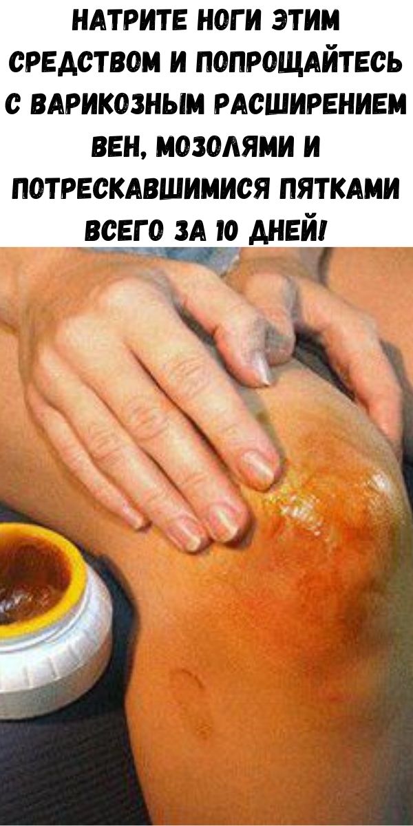 Натрите ноги этим средством и попрощайтесь с варикозным расширением вен, мозолями и потрескавшимися пятками всего за 10 дней!