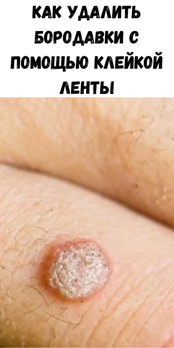 Как удалить бородавки с помощью клейкой ленты