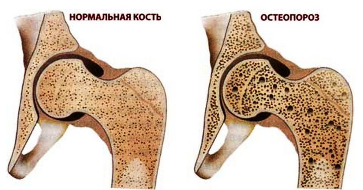 Кости при остеопорозе фото