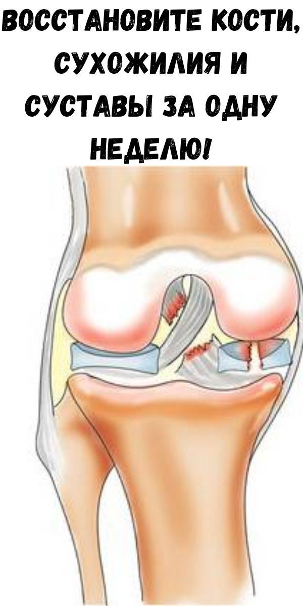 Восстановите кости, сухожилия и суставы за одну неделю!