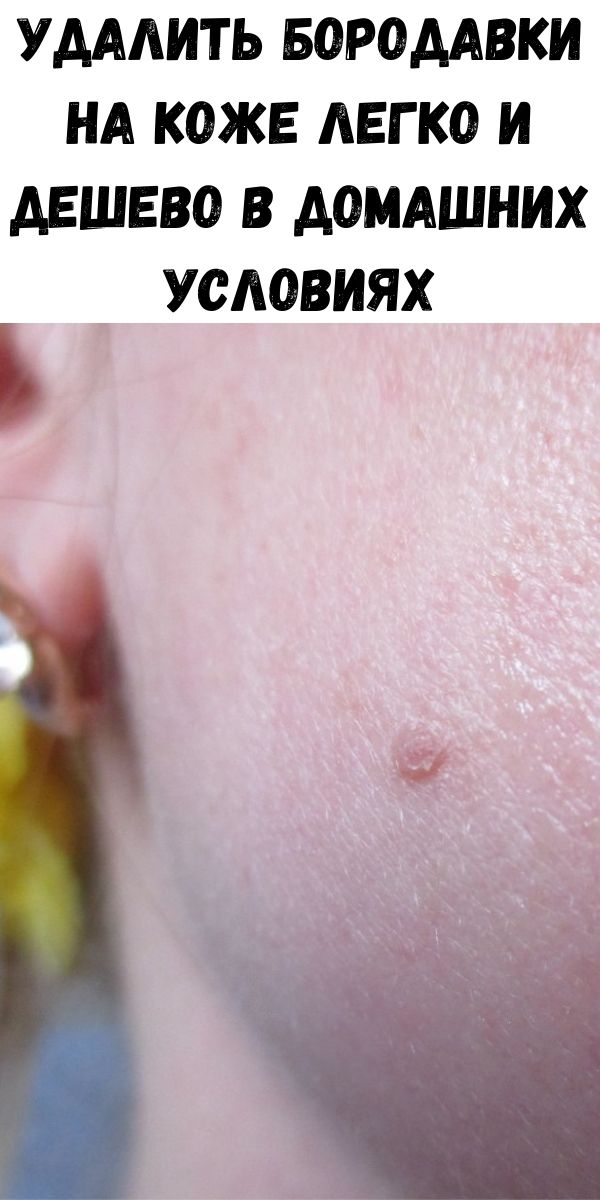 Удалить бородавки на коже легко и дешево в домашних условиях