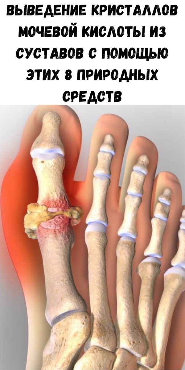 Выведение кристаллов мочевой кислоты из суставов с помощью этих 8 природных средств