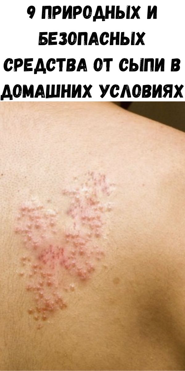 9 природных и безопасных средства от сыпи в домашних условиях