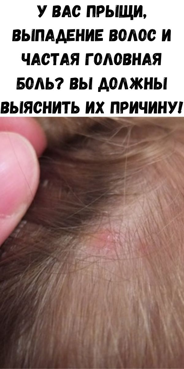 У Вас прыщи, выпадение волос и частая головная боль? Вы должны выяснить их причину!
