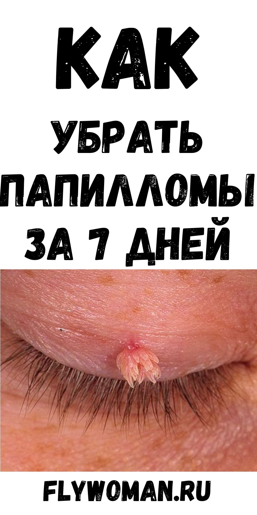 Удивительный трюк, чтобы удалить папилломы с&nbsp;Вашего тела всего за 1 неделю