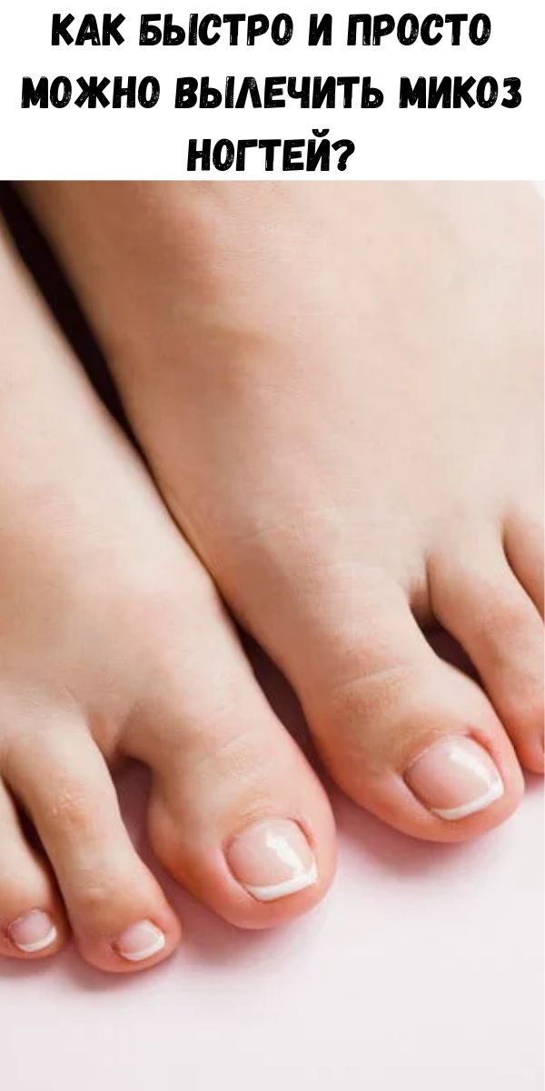 Как быстро и просто можно вылечить микоз ногтей? - Советы для женщин