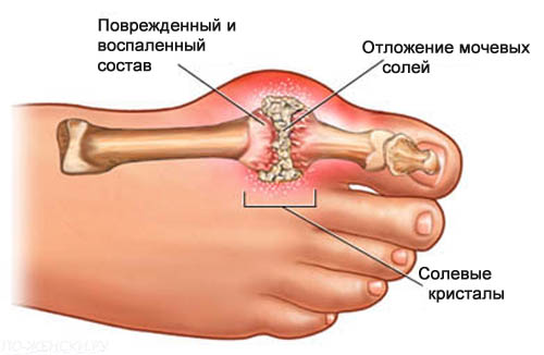 Как избавиться от подагры и боли в суставах (мочевая кислота и кристаллы) Как избавиться от подагры и боли в суставах (мочевая кислота и кристаллы)
