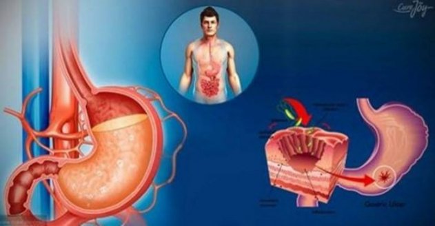 5 продуктов, которые вы не должны есть, если у вас изжога и кислотный рефлюкс 5 продуктов, которые вы не должны есть, если у вас изжога и кислотный рефлюкс