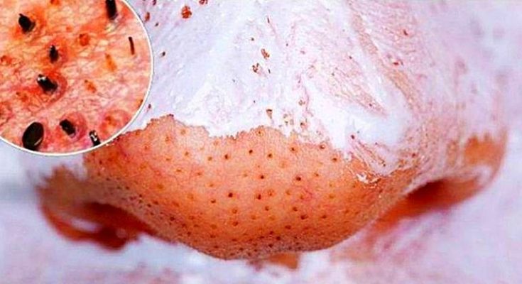 Как смешивать кокосовое масло и пищевую соду для очистки лица Как смешивать кокосовое масло и пищевую соду для очистки лица