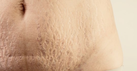 5 природных методов предотвращения растяжек (и как от них избавиться) 5 природных методов предотвращения растяжек (и как от них избавиться)