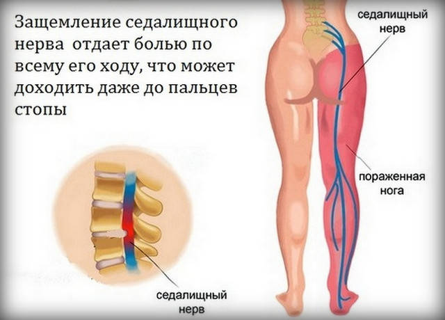 Ишиас. Что делать в случае защемления седалищного нерва? Как справиться с болью?