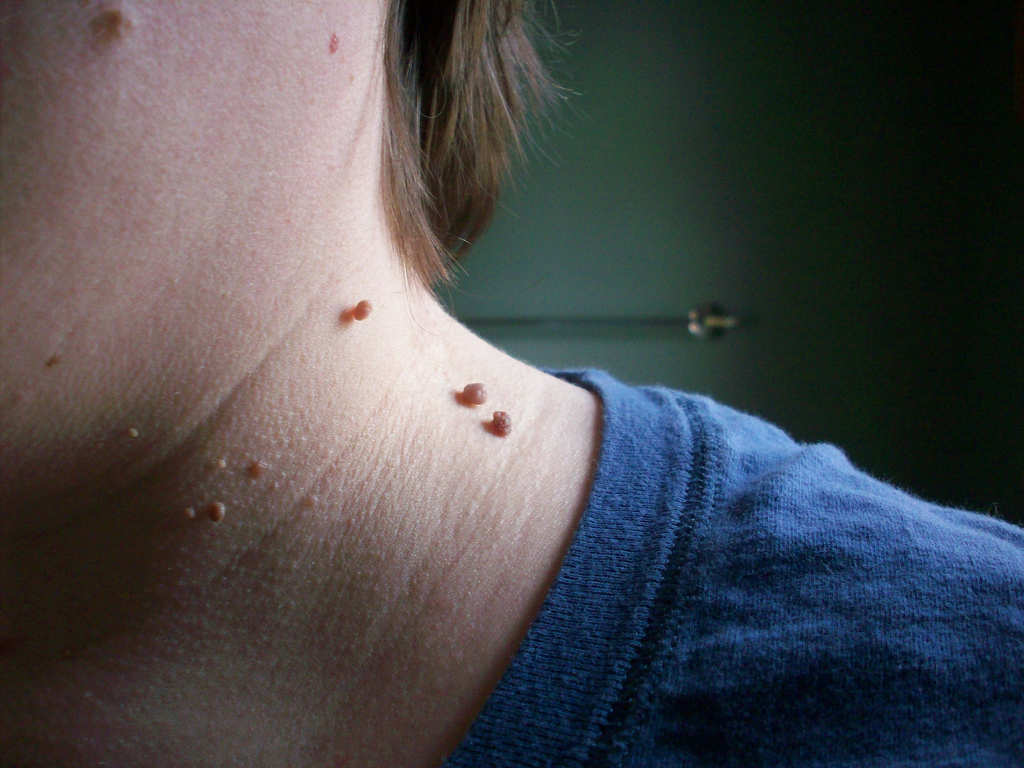 Как удалить папилломы хозяйственным мылом Как удалить папилломы хозяйственным мылом
