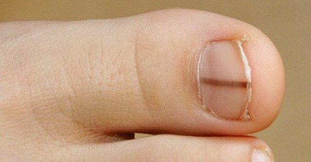 Если Вы заметили черный след на ногте, Вам стоит поспешить в больницу. И вот почему!..